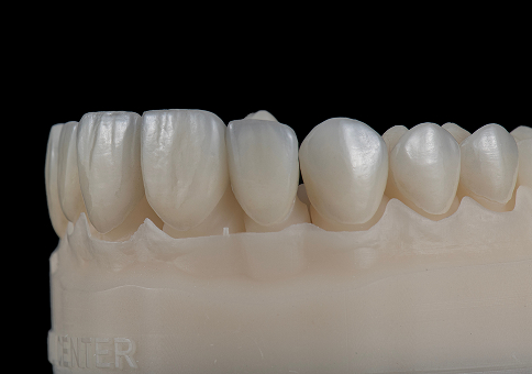 EMAX Veneers