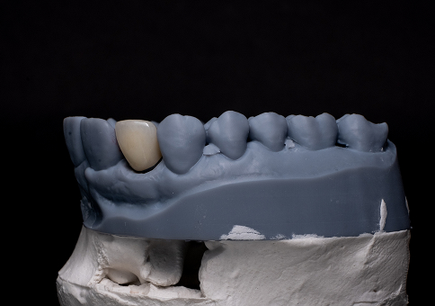 EMAX Veneers