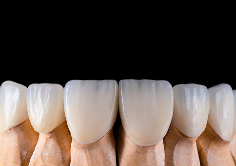 EMAX Veneers